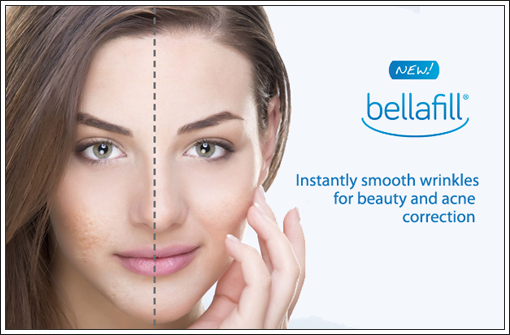 bellafill Minneapolis facial filler procedure